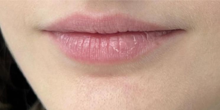 Escultura Labial con Ácido Hialurónico