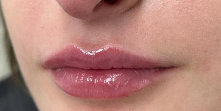 Escultura Labial con Ácido Hialurónico