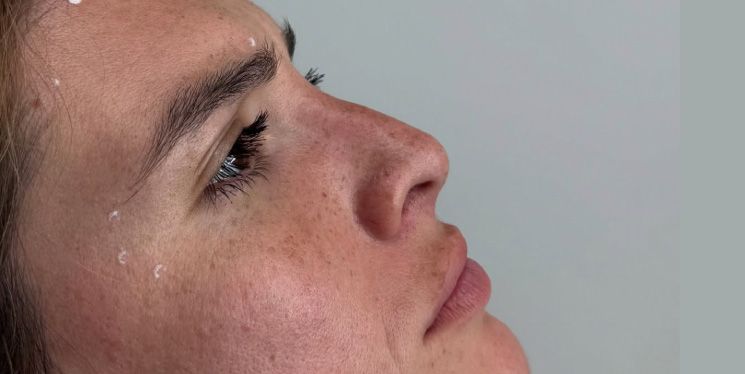 Labios más rinomodelación