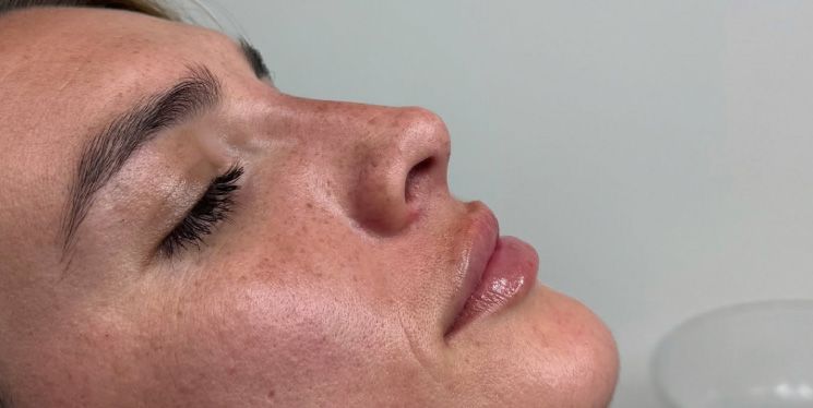Labios más rinomodelación