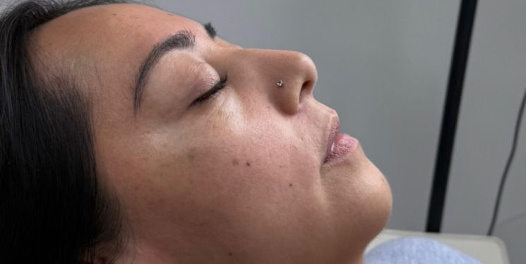 Perfiloplastia