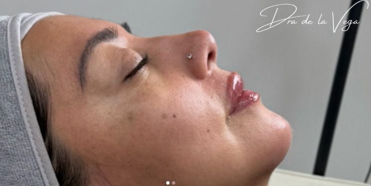 Perfiloplastia