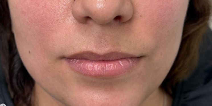 Relleno de Labios