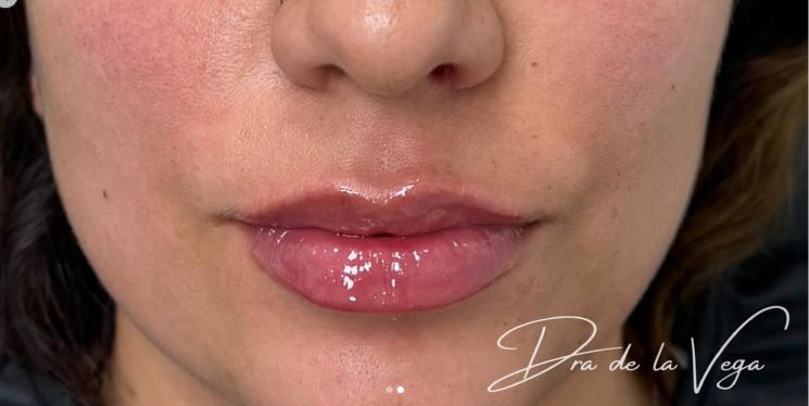 Relleno de Labios